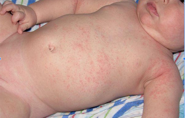 Children with heat rash need to do?  - first