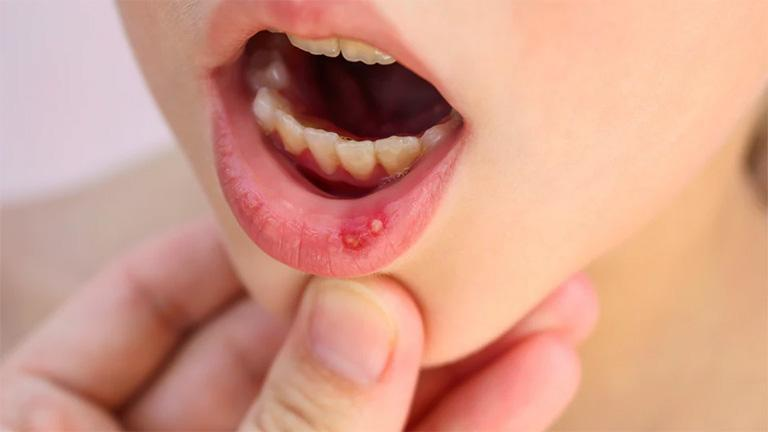 What to do if a child has a cold sore?  - 2