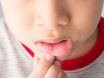 Trẻ bị nhiệt miệng phải làm sao?