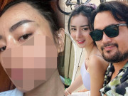 Làm đẹp - Hotgirl miền Tây lấy tỷ phú Thái đi nâng cơ mặt nhận về cái kết kích ứng bỏng da