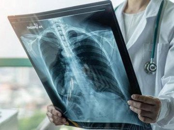 4 nhóm người có nguy cơ bị xơ phổi hậu COVID-19, có dấu hiệu này cần đi khám sớm!