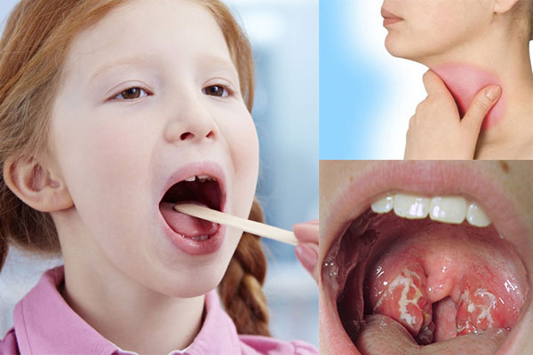 What to do when a child has a sore throat?  - first