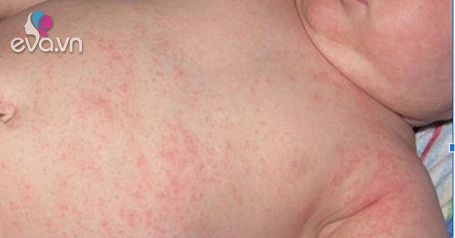 Children with heat rash need to do?