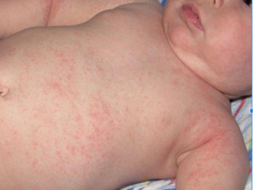 Trẻ bị rôm sảy cần phải làm thế nào?