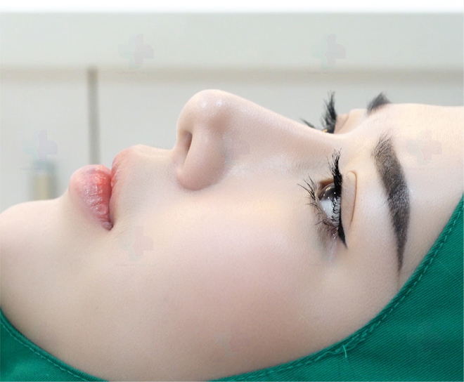 Các phương pháp nâng mũi amp;#34;để đờiamp;#34; của bác sĩ Lê Quý  - 2