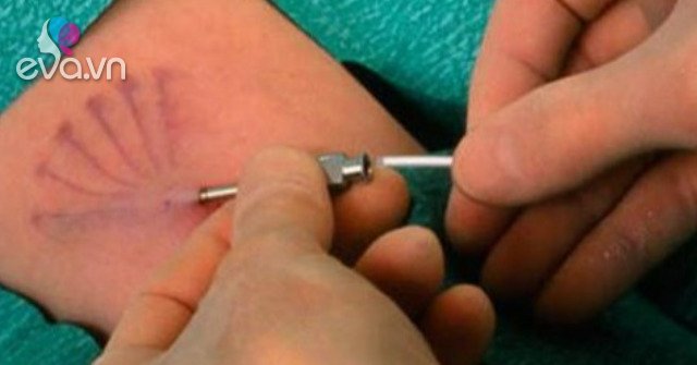 25 women who implanted contraceptives got pregnant, discovered the shocking truth about male doctors
