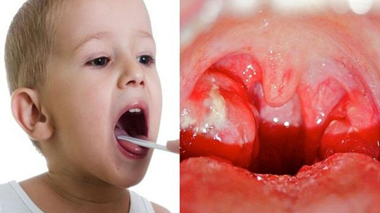 Children with tonsillitis should be treated like?  - first