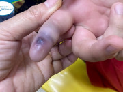 Sức khỏe - Mua rắn độc về nuôi làm thú cưng, bé trai Hà Nội bị rắn cắn nguy hiểm tính mạng