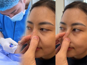 Làm đẹp - Đi nâng mũi, gái xinh nhận về cái kết sống mũi biến chứng, cầm lắc được như xiếc