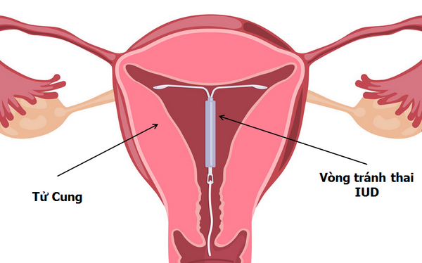 Ưu và nhược điểm của 10 biện pháp tránh thai hiện nay bạn nên biết - 2