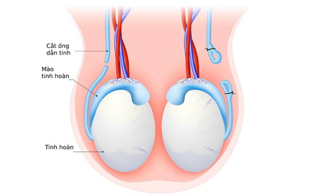 Ưu và nhược điểm của 10 biện pháp tránh thai hiện nay bạn nên biết - 9