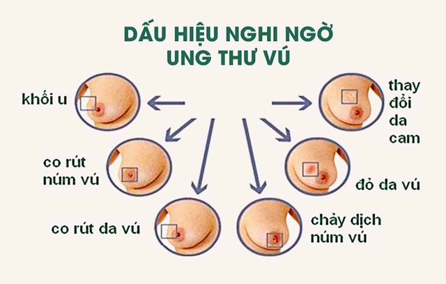 Chuyên gia cảnh báo 8 kiểu phụ nữ này dễ mắc ung thư vú, bạn có trong số đó không? - 4