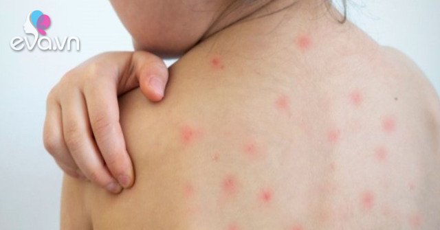 Why does the child have a rash but no fever?