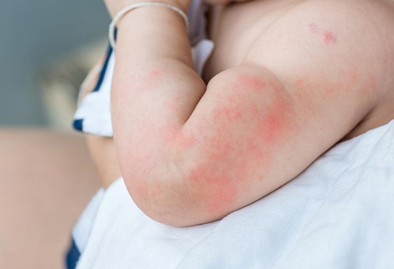 Why does the child have a rash but no fever?  - first