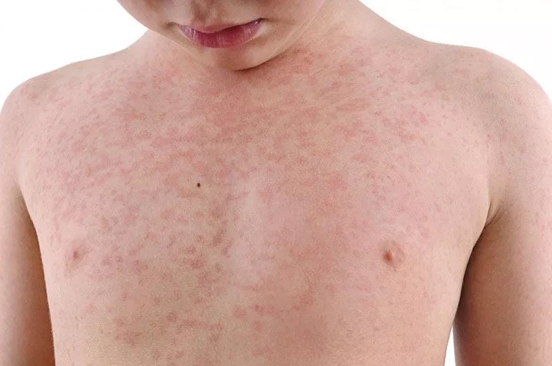 Why does the child have a rash but no fever?  - 4