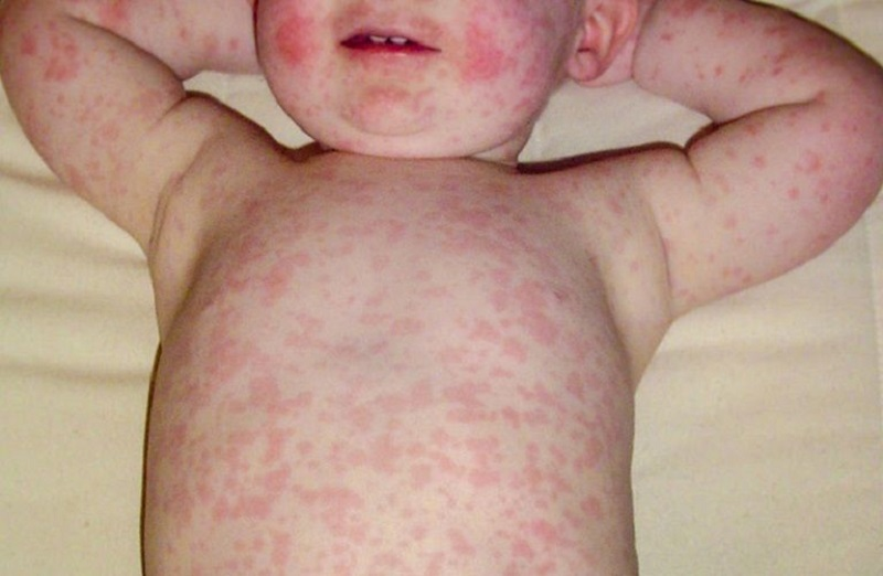 Why does the child have a rash but no fever?  - 3