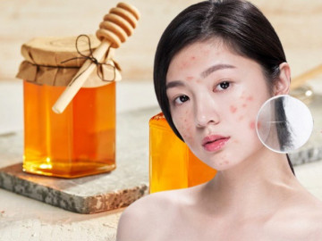 Trị mụn bằng mật ong tại nhà: bí quyết giúp da nàng sáng khỏe mà chẳng tốn nhiều tiền