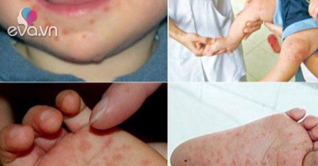 Signs of children with hand, foot and mouth disease and how to take care