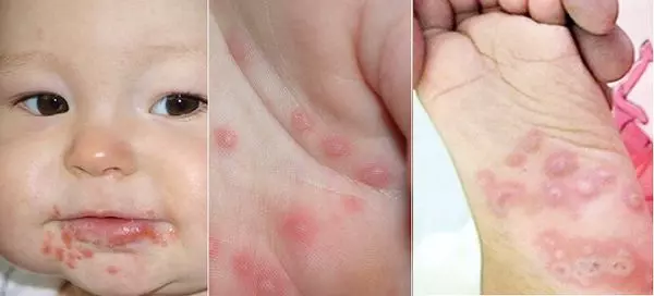 Signs of children suffering from hand, foot and mouth disease and how to take care - 1