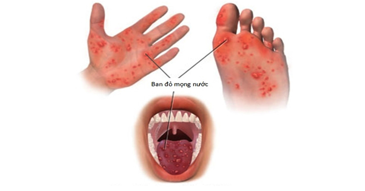 Signs of children suffering from hand, foot and mouth disease and how to take care - 2
