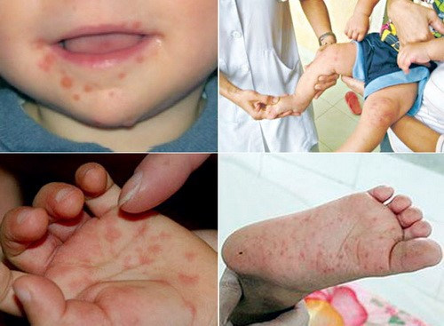 Signs of children suffering from hand, foot and mouth disease and how to take care - 4