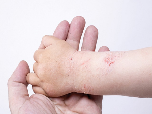 What are the signs of dengue fever in children?  - first