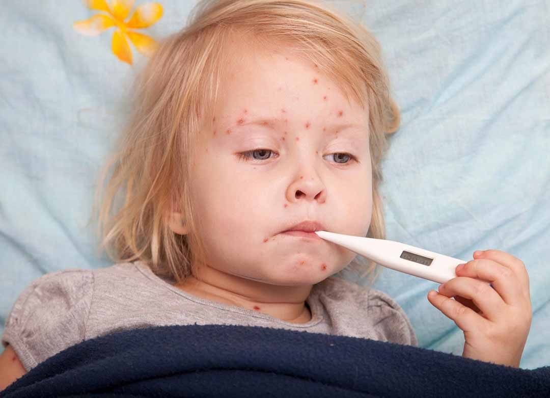 What are the signs of dengue fever in children?  - 5