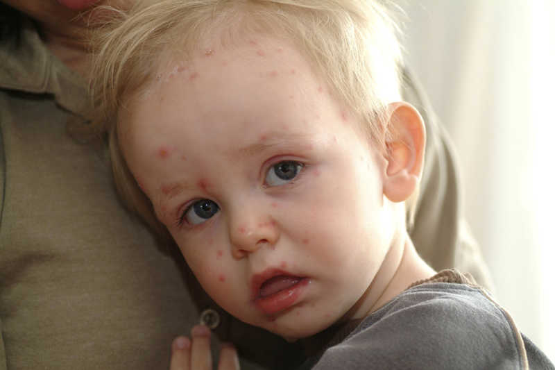 Sốt siêu vi và sốt xuất huyết ở trẻ khác nhau như thế nào? - 3