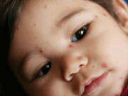 Sốt siêu vi và sốt xuất huyết ở trẻ khác nhau như thế nào?