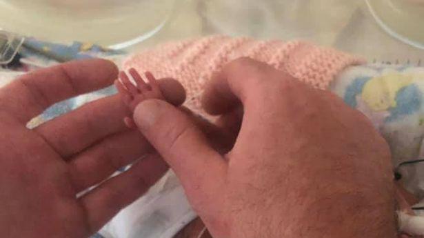 The baby was born prematurely weighing only 5 kg, the hand is as small as the father's finger, the image after 1 year is surprising - 2