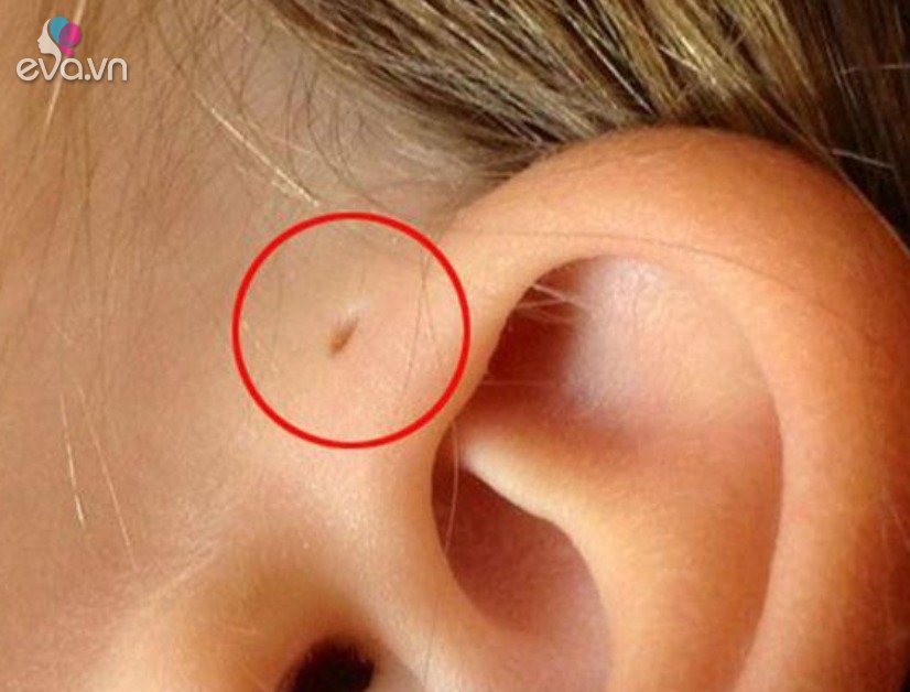 The child was hospitalized because his mother used to massage this smart hole in his ear, 3 positions parents should not arbitrarily touch
