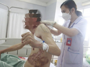 Người đàn ông Quảng Ninh lở loét, sẹo khắp người vì mồ hôi tiết ra mủ hiếm gặp