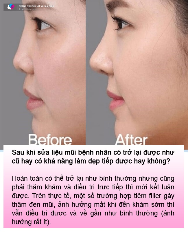 Cô em gái dại dột tiêm filler mũi tím đen cả mắt, chị gái rầu rĩ cầu cứu MXH - 9