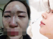 Làm đẹp - Cô em gái dại dột tiêm filler mũi tím đen cả mắt, chị gái rầu rĩ cầu cứu MXH