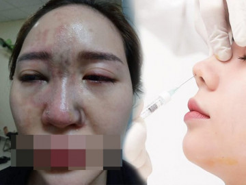 Cô em gái dại dột tiêm filler mũi tím đen cả mắt, chị gái rầu rĩ cầu cứu MXH