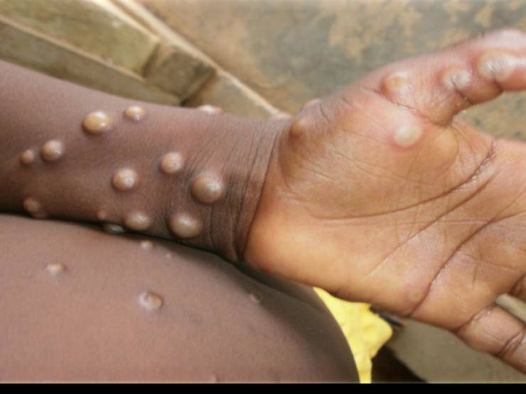 Ministry of Health: Closely monitor monkeypox in humans - 1