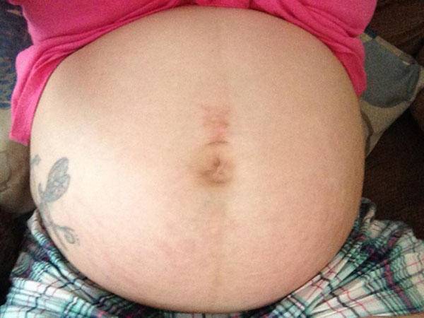 Mẹ bầu thường có đường sọc nâu giữa bụng, ý nghĩa của nó là gì? - 3