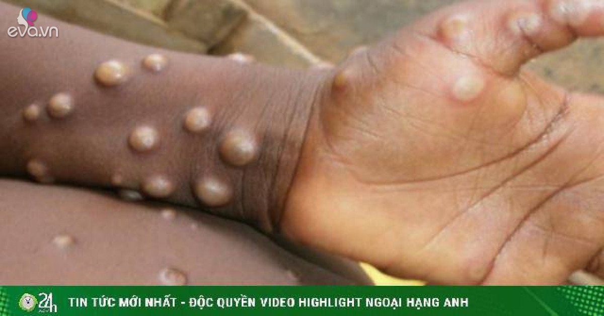 Close surveillance of monkeypox in humans