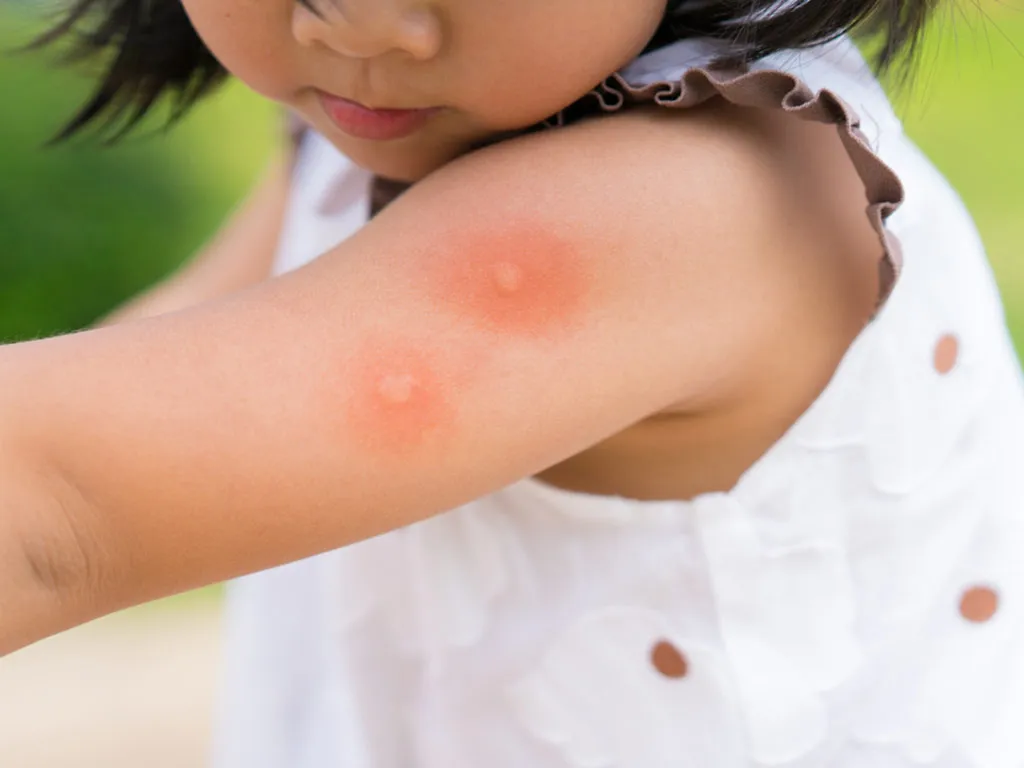 Manifestations of severe dengue fever in children - 1