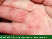 Sức khỏe - Bệnh tay chân miệng ở Hà Nội tăng nhanh, cha mẹ cần chú ý dấu hiệu nặng