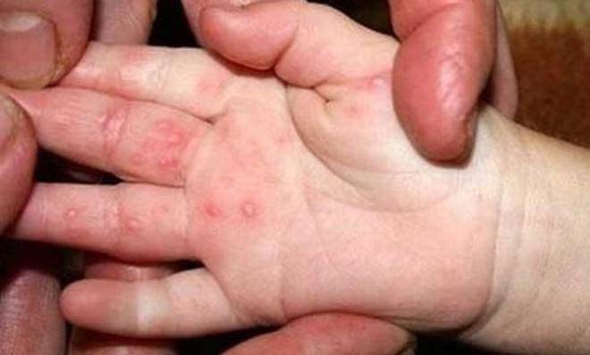 Hand, foot and mouth disease in Hanoi is increasing rapidly, parents need to pay attention to serious signs - 1