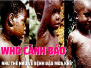 Clip Eva - Bệnh đậu mùa khỉ: WHO cảnh báo thế nào