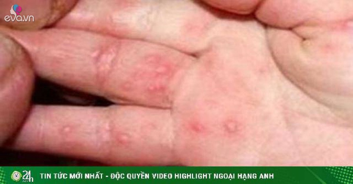 Hand, foot and mouth disease in Hanoi is increasing rapidly, parents need to pay attention to serious signs