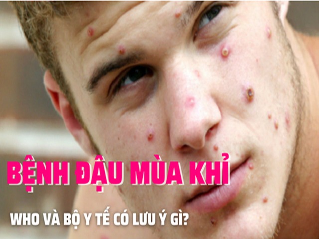 Bộ Y tế hướng dẫn gì về bệnh đậu mùa khỉ?