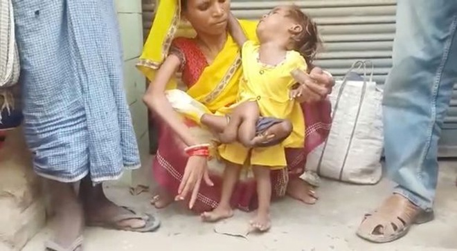 Baby girl has 2 extra arms and 2 legs growing out of her stomach, mother is in shock when giving birth - 1