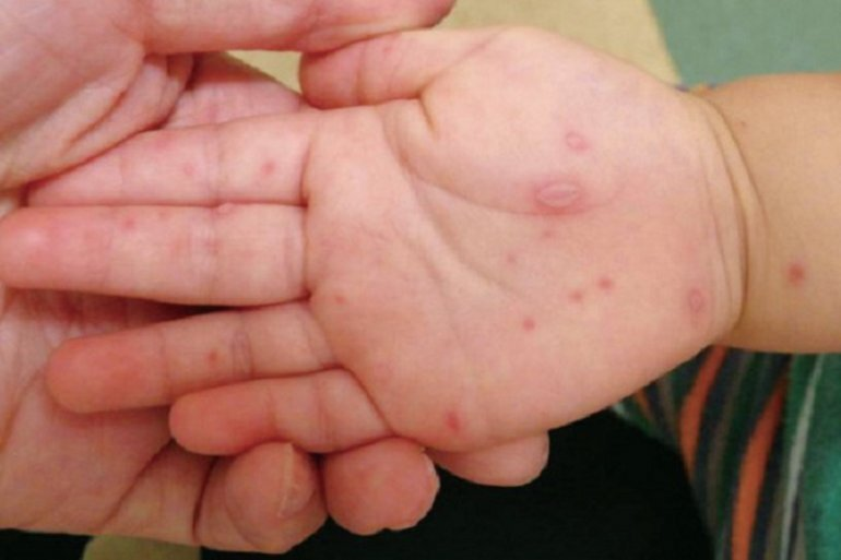 Is hand, foot and mouth disease contagious in children?  - 3