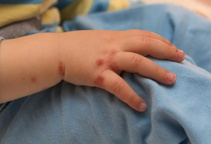 Is hand, foot and mouth disease contagious in children?  - 4