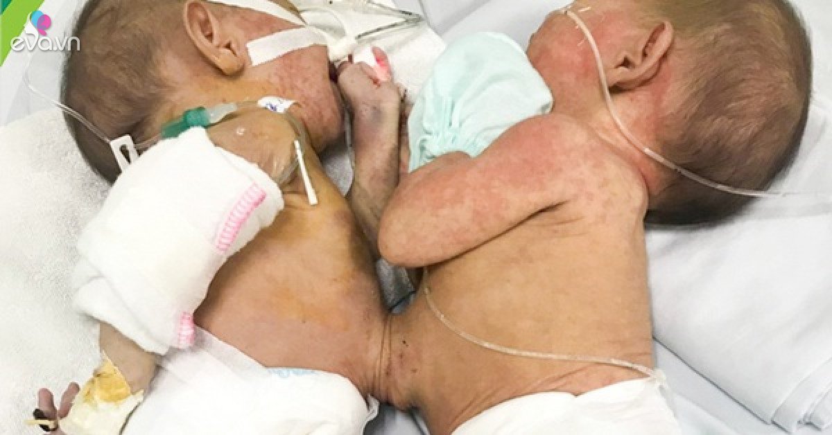 Conjoined twins are rare in Lao Cai, 200,000 babies have only one case