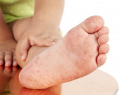 Làm mẹ - Phân độ chân tay miệng ở trẻ em như thế nào?