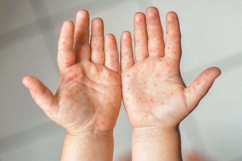 Is hand, foot and mouth disease contagious in children?  - first